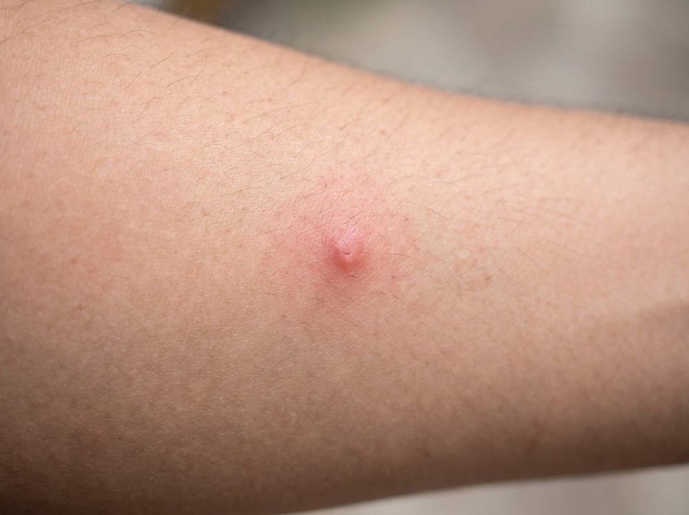 Close-up photograph of a scattered red welted skin rash caused by carpet beetle larvae hair contact on forearm skin